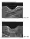 Fig. 10 - Cutting Edge with Microscopically Sized Channels to Enhance Cutting Performance