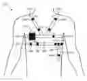 Fig. 01 - RESPIRATION RATE MONITORING BY MULTIPARAMETER ALGORITHM IN A DEVICE INCLUDING INTEGRATED BELT SENSOR