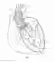 Fig. 02 - Systems for replacing a native heart valve and aorta with a prosthetic heart valve and conduit