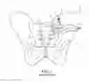 Fig. 02 - Method of fusing a sacroiliac joint with an implant with struts