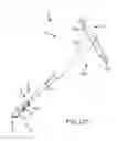 Fig. 116 - Method of fusing a sacroiliac joint with an implant with struts