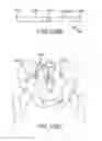 Fig. 118 - Method of fusing a sacroiliac joint with an implant with struts