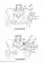 Fig. 134 - Method of fusing a sacroiliac joint with an implant with struts