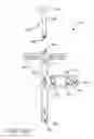 Fig. 140 - Method of fusing a sacroiliac joint with an implant with struts