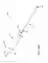 Fig. 157 - Method of fusing a sacroiliac joint with an implant with struts
