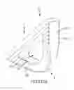 Fig. 168 - Method of fusing a sacroiliac joint with an implant with struts