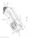 Fig. 193 - Method of fusing a sacroiliac joint with an implant with struts