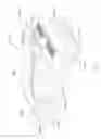 Fig. 210 - Method of fusing a sacroiliac joint with an implant with struts