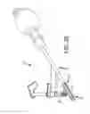 Fig. 25 - Method of fusing a sacroiliac joint with an implant with struts