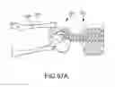 Fig. 52 - Method of fusing a sacroiliac joint with an implant with struts