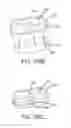 Fig. 66 - Method of fusing a sacroiliac joint with an implant with struts