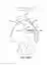 Fig. 69 - Method of fusing a sacroiliac joint with an implant with struts