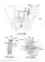 Fig. 70 - Method of fusing a sacroiliac joint with an implant with struts