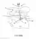 Fig. 72 - Method of fusing a sacroiliac joint with an implant with struts