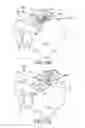 Fig. 73 - Method of fusing a sacroiliac joint with an implant with struts