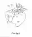 Fig. 74 - Method of fusing a sacroiliac joint with an implant with struts