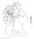 Fig. 75 - Method of fusing a sacroiliac joint with an implant with struts