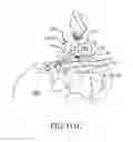 Fig. 82 - Method of fusing a sacroiliac joint with an implant with struts