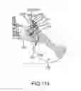 Fig. 87 - Method of fusing a sacroiliac joint with an implant with struts