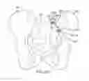 Fig. 89 - Method of fusing a sacroiliac joint with an implant with struts