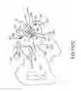 Fig. 91 - Method of fusing a sacroiliac joint with an implant with struts
