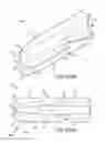 Fig. 95 - Method of fusing a sacroiliac joint with an implant with struts