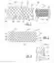 Fig. 02 - Woven stent device and manufacturing method