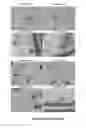 Fig. 44 - INTRAMUSCULAR ADMINISTRATON OF AUTOLOGOUS BONE MARROW FOR TREATMENT