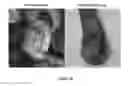 Fig. 52 - INTRAMUSCULAR ADMINISTRATON OF AUTOLOGOUS BONE MARROW FOR TREATMENT