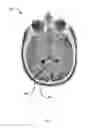 Fig. 06 - Method, system and apparatus for image-guided insertion of implant devices
