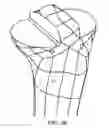 Fig. 35 - Patient-matched instrumentation and methods