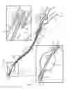 Fig. 02 - Increased axial load carrying sheathed irrigating balloon catheter