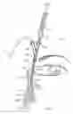 Fig. 05 - Increased axial load carrying sheathed irrigating balloon catheter