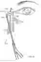 Fig. 07 - Increased axial load carrying sheathed irrigating balloon catheter