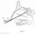 Fig. 09 - Increased axial load carrying sheathed irrigating balloon catheter