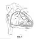 Fig. 02 - Medical device retrieval with multiple snares