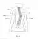 Fig. 02 - External adjustment device for distraction device