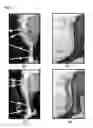 Fig. 02 - Reduction methods for aligning bone segments using customized jigs