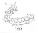 Fig. 03 - Multi-unit dental assembly with off-axis feature