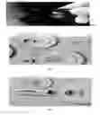 Fig. 04 - Dentures (false teeth) made permanent using vacuum suction