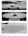 Fig. 07 - Dentures (false teeth) made permanent using vacuum suction