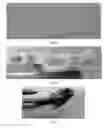 Fig. 08 - Dentures (false teeth) made permanent using vacuum suction