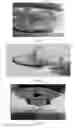 Fig. 09 - Dentures (false teeth) made permanent using vacuum suction
