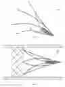 Fig. 65 - VASCULAR FILTER DEVICE