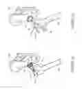 Fig. 06 - Method and apparatus for post-operative tuning of a spinal implant