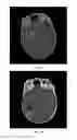 Fig. 45 - Retinoid compositions and methods of increasing immune cell-mediated killing of IDH mutant cancer cells
