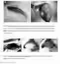 Fig. 03 - BIOCOMPATIBLE CARBOXYMETHYLCELLULOSE MATRIX (BCM) FOR HEMOSTASIS, TISSUE BARRIER, WOUND HEALING, AND COSMETOLOGY
