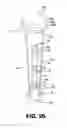Fig. 09 - Plunger locking assembly for a fat transfer syringe