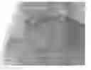 Fig. 01 - Systems and methods for percutaneous body lumen drainage