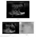 Fig. 02 - Systems and methods for percutaneous body lumen drainage